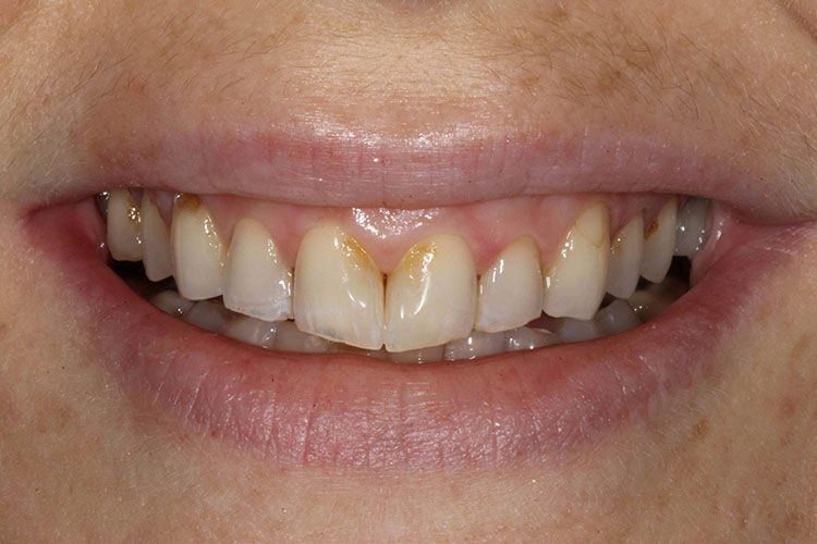 Dr. Pinnix's patient with stained, worn teeth