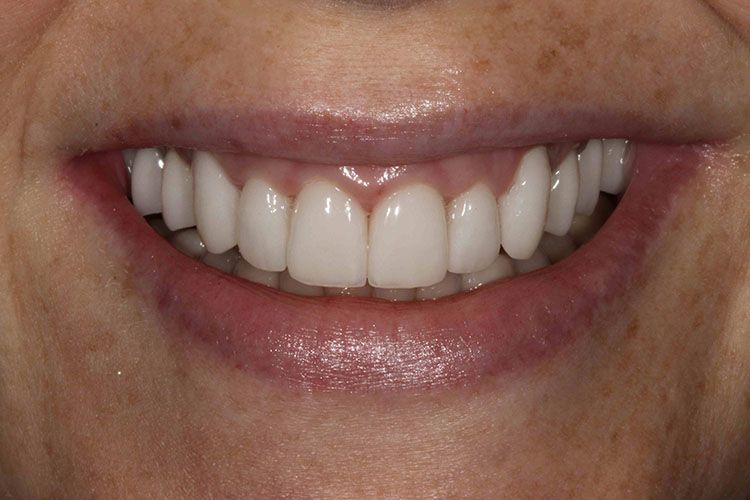 Dr. Pinnix's patient after a smile makeover