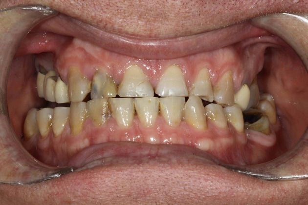 Before crown placement