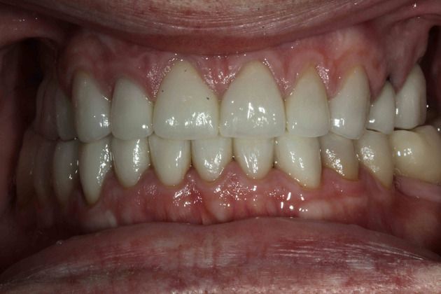 After crown placement